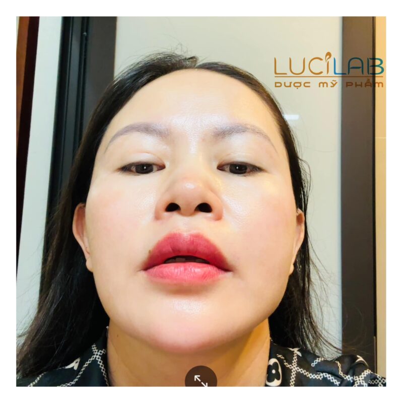 Phương Loan - của HIỆN TẠI sau khi ĐIỀU TRỊ NÁM THÀNH CÔNG