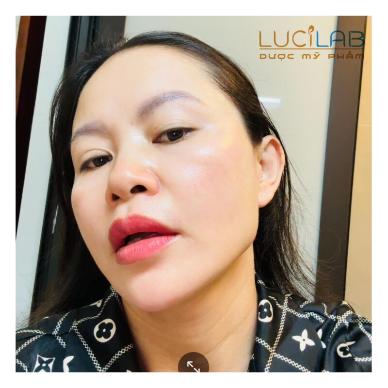 Phương Loan - của HIỆN TẠI sau khi ĐIỀU TRỊ NÁM THÀNH CÔNG - BÊN TRÁI