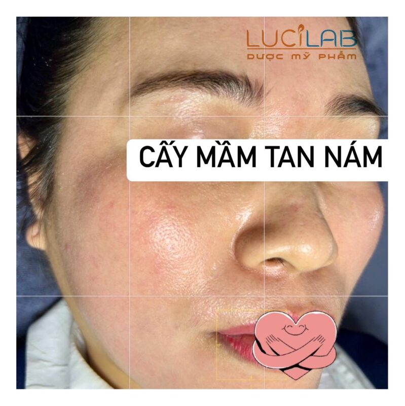 KẾT QUẢ Ảnh khách hàng SAU KHI ĐIỀU TRỊ NÁM TẠI Thẩm mỹ viện Mun's - và sử dụng công nghệ Cấy mầm tan Nám Lucilab