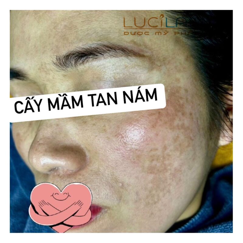 Ảnh MÁ TRÁI khách hàng bị NÁM khi chưa ĐIỀU TRỊ tại Thẩm mỹ viện Mun's - và sử dụng công nghệ Cấy mầm tan Nám Lucilab