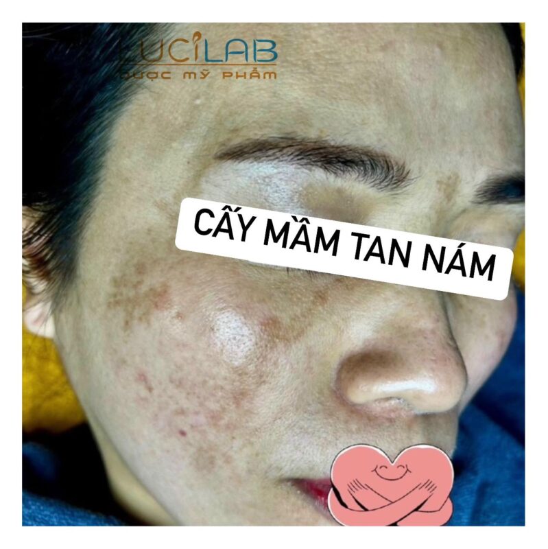 Ảnh MÁ PHẢI khách hàng bị NÁM khi chưa ĐIỀU TRỊ tại Thẩm mỹ viện Mun's - và sử dụng công nghệ Cấy mầm tan Nám Lucilab